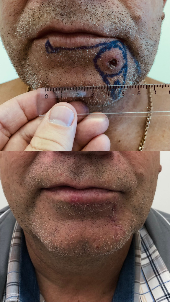 Результат хирургического лечения базалиомы нижней губы